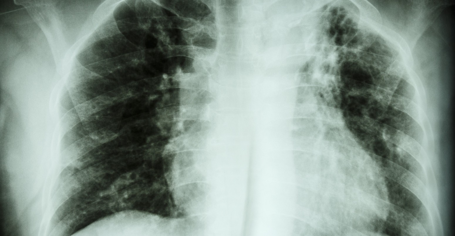 Chest X-ray of pulmonary tuberculosis